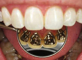 Brackets Linguales - HC Odontologos - Clinica Dental Merida