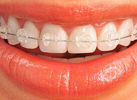 Brackets de Zafiro - HC Odontologos - clinica dental merida