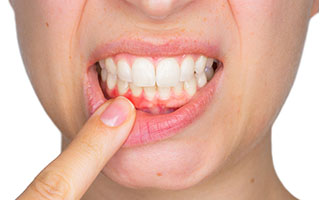 Enfermedad Periodontal - HC Odontologos- Clinica Dental Merida