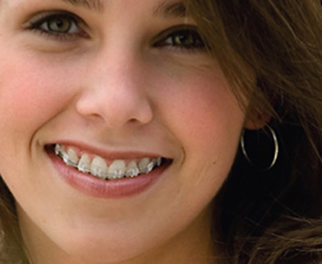 ¿Cuánto Tiempo Dura un Tratamiento con Brackets?