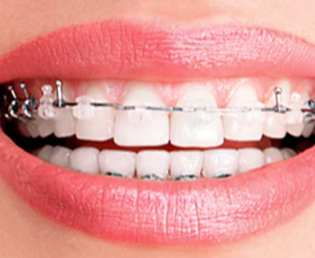 que tipo de brackets necesito