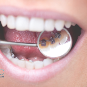 Ventajas y desventajas de la ortodoncia lingual - Dr. Rubén Herrera | Especialista en Ortodoncia - Ortodoncia Merida