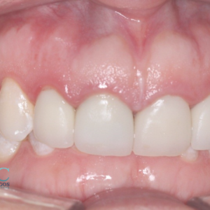 ¿Qué es la sobremordida y cuáles son los tratamientos? - Dr. Rubén Herrera | Especialista en Ortodoncia - Ortodoncia Merida