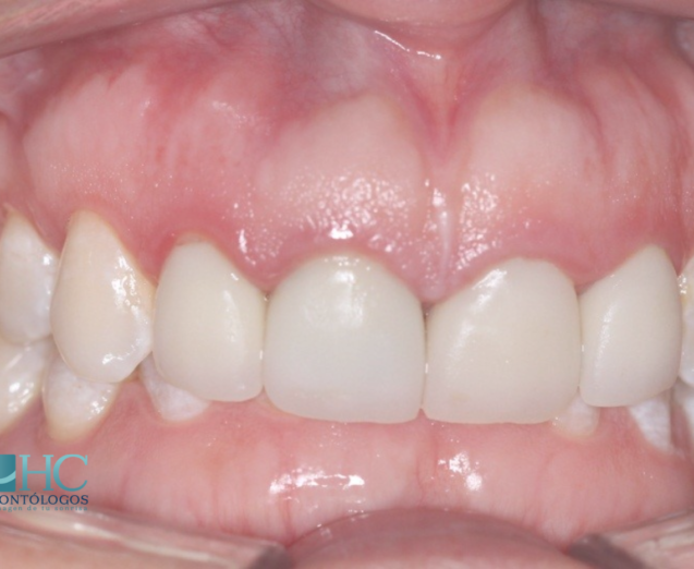 ¿Qué es la sobremordida y cuáles son los tratamientos? - Dr. Rubén Herrera | Especialista en Ortodoncia - Ortodoncia Merida